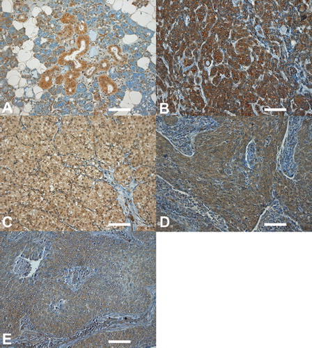 Figure 1. Immunohistochemical stainings of MMP-7 in salivary gland cancer. The intensity of the cytoplasmic staining on a scale from 0 to 3 and the percentage of staining cells in parentheses. (A) Healthy salivary gland tissue. The intensity of epithelial cells stained is 1, some of the acinar cells are positive; (B) AdCC (3, 95%). Staining of nuclei is also visible; (C) AcCC (1, 40%). Some nuclei are stained; (D) MEC (2, 30%); (E) SDC (1, 30%). Scale bars: A, B, C, D, 100 μm.