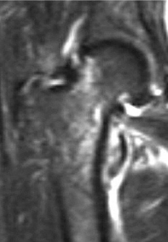 An STIR image showing high signal areas surrounding the fracture (white and light gray) and extending towards the lesser trochanter, indicating a recent trauma.