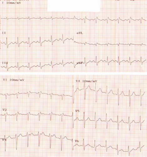 Fig. 2.  A 12-lead ECG showing BEP subsided after 150 mEq NaHCO3 given in emergency department.