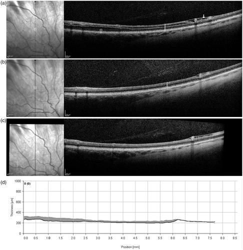 FIGURE 1. Right eye vertical SD-OCT line scans of the superior retina (about 10° to 40° from foveal center) at baseline, prior to treatment (a), and after 3 months (b) and 6 months (c) of treatment on topical dorzolamide 2% TID OU. At baseline (a), note splitting of the retina in the outer nuclear layer (open arrow), inner nuclear layer (vertical white line), and retinal nerve fiber layer (closed arrow). At follow-up the splitting is markedly reduced in both the outer and inner nuclear layers, while splitting of the retinal nerve fiber layer remained. No change from baseline to follow-up is seen in the outer segment ellipsoid layer, retinal pigment epithelial layer or posterior vitreous. The retinal thickness (from internal limiting membrane to Bruch’s membrane) at the location marked by the vertical white line in the SD-OCT images is 233 microns at baseline (a) and 207 microns at follow-up (b). The OCT line scan in (c) is aligned with a baseline OCT line scan, and the thickness profile difference is shown in (d) as the shaded gray area.
