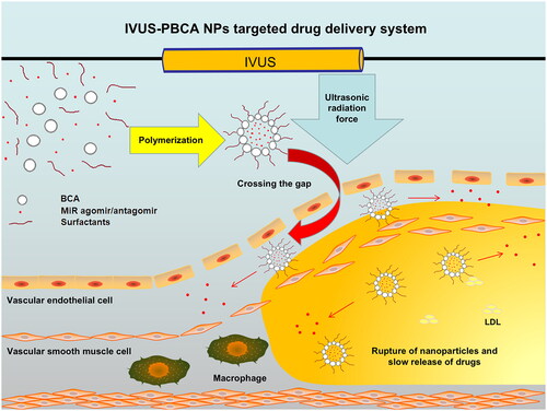 Figure 10. Schematic diagram of intravascular ultrasound (IVUS)-PBCA NPs targeted drug delivery system. Abbreviations: LDL, low density lipoprotein.