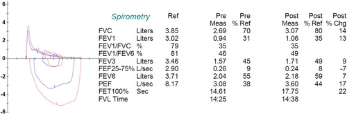 Figure 4 Pre- and Post-Bronchodilator spirometry of a patient with severe COPD. Pre/Post Bronchodilator responses indicating severe (0.94 L, 30% of predicted) reduction in FEV1 and a very low FEV1/FVC (35%). There is a bronchodilator response that meets ATS/ERS criteria (>12% and 200 mL in either FEV1 or FVC). Further lung function results were: The total lung capacity (TLC) is normal (6.57 L or 96% predicted) and the diffusing capacity for carbon monoxide (DLco) is 107 mL/min/mmHg or 37% of predicted (not shown). Reference values for spirometry were according to Hankinson (Citation55), for the lung volumes were according to the ECSC (Citation56) and for the diffusion capacity by Miller et al. (Citation57). Reprinted with permission of the American Thoracic Society. Copyright© 2018 American Thoracic Society (Citation57). American Review of Respiratory Disease is an official journal of the American Thoracic Society.