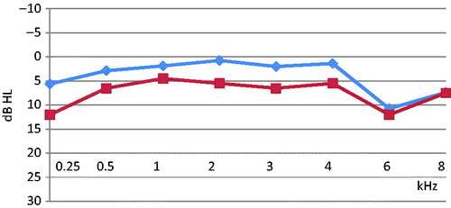 Figure 4. Left hearing thresholds for 50 adolescents with NH who preferred two different PMP listening levels: no 40: ≤85 dB (diamonds) and no 10: ≥85 dB (squares).