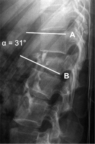 Figure 2. Lateral view of the thoracolumbar spine on a conventional radiograph after an AO type B1.2 fracture of L1. The segmental angle (α) was determined by measuring the angle between the line (B) parallel to the lower endplate of the fractured vertebra and the line (A) parallel to the upper endplate of the adjacent proximal vertebra (Keynan et al. Citation2006).
