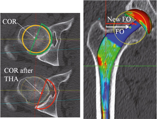 Figure 4. In some cases of dysplastic acetabula, the center of rotation has to be shifted medially. The FO may be increased in order to compensate for the decrease in acetabular offset and to avoid instability.