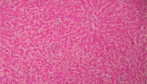 Figure 8.  Liver section of PdAE (200 mg/kg) and CCl4 shows mild fatty changes, necrosis, mild ballooning with degeneration and mild infiltration of lymphocytes.