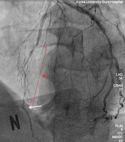 Figure 1. Coronary angiography showing near total occlusion of the left anterior descending artery. The length of the occlusion involves a long segment of the middle portion of the artery (asterisk). The suitable bypass area is fairly distal (white arrow).