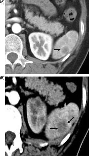 Figure 2. Transverse contrast-enhanced CT scans in the 56-year-old woman with lung adenocarcinoma metastasis. (A) Preablation scan showed one solitary neoplasm (arrow) with low attenuation and peripheral enhancement at the lower pole of the spleen. (B) On an arterial phase CT scan obtained 28 months after treatment no enhancement is seen in the enlarged coagulation zone (arrows), suggesting the absence of residual tumour.