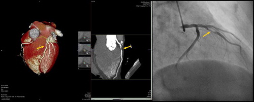 Figure 1. Stenosis in the left anterior descending branch (arrow) diagnosed on CT coronary angiography (left) and invasive coronary angiography (right).