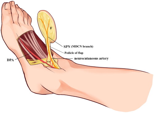 Figure 5. Illustration of the superficial peroneal neurocutaneous flap harvesting in proximally based design. SPN, superficial peroneal nerve; DPA, dorsalis pedis artery; F, skin flap; Asterisk (**), perforating branches from DPA and ATA.