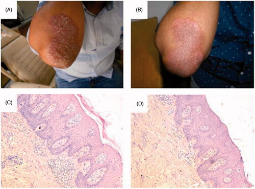 Figure 5. Patient with psoriatic plaques over the right elbow before treatment with microemulsion/laser combination (A,C) and after 8 weeks of treatment (B,D), showing a decreased epidermal thickness.