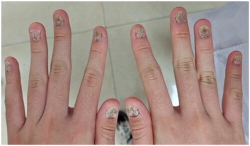 Figure 1. Nails psoriasis at both hands. All of the fingernails on both hands were dystrophic, with different degrees of trachyonychia, longitudinal striations, and discoloration.