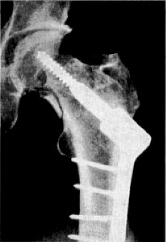 Figure 7.  Sliding screw-plate.