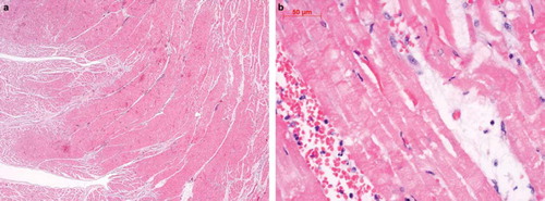 Figure 1a,b. Hematoxylin-eosin-stained sections of the left ventricle obtained at autopsy. Figure 1a shows a recent infarction of the interior ventricular myocardium (10×), Figure 1b shows a section of endocardial region with an acute infarction of the subendocardial myocardium at higher power (40×).