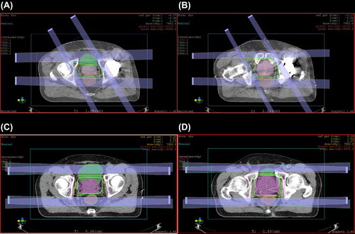 Figure 1. Dose distribution and beam arrangement of patients treated with a lateral- and anterior-oriented beam (A and B) and laterally oriented beams (C and D). (A) CT slice demonstrating trajectory of anterior-oriented beam through the bladder. (B) CT slice demonstrating trajectory of anterior-oriented beam through isocenter. (C) CT slice demonstrating trajectory of lateral beams through the bladder. (D) CT slice demonstrating trajectory of lateral beams through isocenter. (Green color wash: Bladder. Brown color wash: Rectum. Red color wash: PTV).