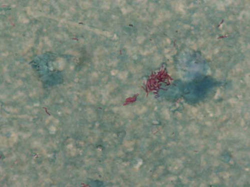 Figure 3. Ziehl–Neelsen (ZN) staining of right ventricular pacing lead vegetation. This shows numerous acid and alcohol fast bacilli (AAFB) on direct staining and grew Mycobacterium fortuitum upon culture.