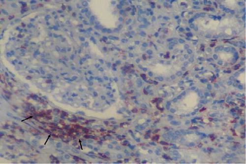 Figure 2. Small T-cell lymphocytes stained by antibodies CD3 infiltration (arrows) in kidney interstitium (ABP, CD3, ×200). ABP, avidin biotin peroxidase method.
