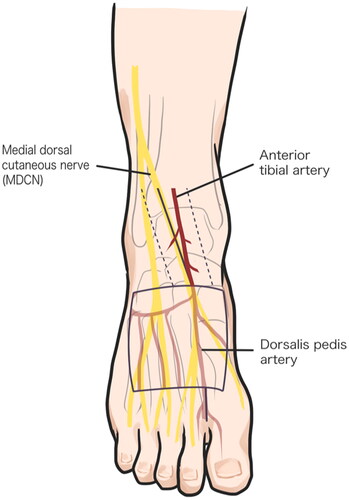 Figure 2. Illustration of SPNC flap designed and drawing. Skin flap was designed over the dorsalis pedis artery and the pedicle of flap was designed along the MDCN trajectory with 3 cm width (dotted line).