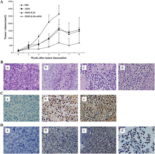 Figure 4. Treatment of NCI-H460 xenograft with ZD55-IL-24 and adriamycin.Tumor size was measured weekly after injection of ZD55-IL-24 (1 × 109 pfu/tumor) or ZD55-EGFP (1 × 109 pfu/tumor). Adriamycin was injected intraperitoneally (4 mg/kg) at the same time. Each group included at least five mice.H&E staining of tumors obtained from mice treated with ZD55-IL-24 and/ or adriamycin. The tumor treated with PBS was used as control.Original magnification ×400. a: PBS as control, b: ADM, c: ZD55-IL24, d: ZD55-IL24+ADM.Immunohistochemical staining with anti-E1A was performed. Original magnification ×400. Original magnification ×400. a: PBS as control, b: ZD55-IL24, c: ZD55-IL24+ADM.Apoptotic study in vivo by TUNEL after treatment with viruses. TUNEL assay was performed to detect apoptosis in the tumor section. Original magnification x400. a: PBS as control, b: ADM, c: ZD55-IL24, d: ZD55-IL24+ADM.