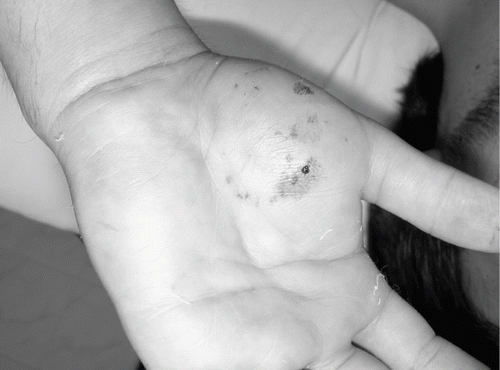 Fig. 2.  Left hand of patient after one hour of the bite by a Guatemalan Beaded Lizard.