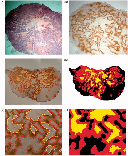 Figure 4. Hypoxia distribution within HT29 colorectal cancer xenografts after 25 days of treatment with ultra-low dose-rate [3H]-valine irradiation. The tumor volumes were approximately 600 mm3. An example is shown in panel A (HE stained slide) and panel B (pimonidazole stained slide visualizing hypoxia in brown). The tumors were widely hypoxic with areas of necrosis throughout the tumors. Hypoxic tumor regions were identified computationally and are shown in red in panels C and D, and in the excerpt in panels E and F. Necrotic regions were manually delineated by visual inspection of both pimonidazole and HE stained slides, as shown in yellow in panels C–F. The remaining tumor tissue is shown in black (panels C–F).