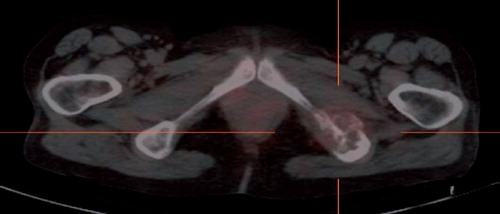 Figure 2. A 111In-octreoitide SPECT/CT in Case 3 patient, after two courses of sunitinib treatment, showing clear regression of 111In-octreoitide uptake in osseous lesion, and corresponding to PR of disease.
