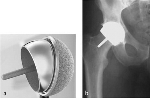 Figure 3a. “Resurfacing” hip prosthesis with large diameter head. 3b. Radiographic appearance.