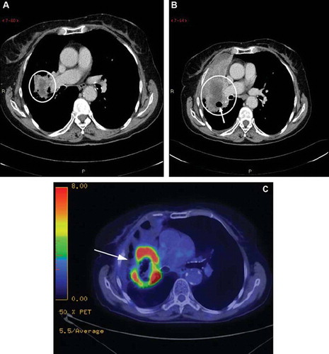 Figure 1. (A) Lung carcinoma in an 81-year-old woman. Transaxial section CT scan from May 22, 2008 obtained at the level of the right pulmonary artery shows a low-density mass adjacent to the right hilus (circle). (B) Image at the same level at ten month follow-up March 2, 2009 shows progress of the mass (circle) with atelectasis ventrally. Note the cavitary air bubble within the mass (arrow). (C) 18F-FDG-PET scan from April 2, 2009 with a pathological uptake of 18F-FDG in the periphery of the tumor (arrow), but not in the central area of necrosis or in the anterior obstructive atelectasis.