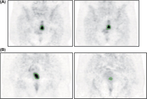Figure 1. Illustration of the baseline scan (on the left) and the scan at 2 weeks (PET3, on the right) for (A) a responder and (B) a non-responder. The green contour is the FLAB delineation.