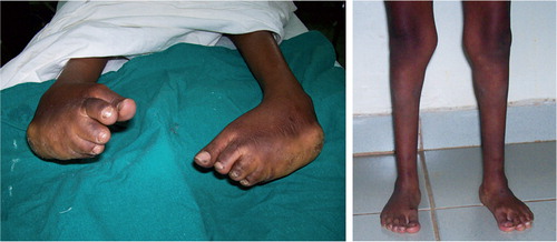 Figure 3. 4-year-old boy before treatment. After treatment.