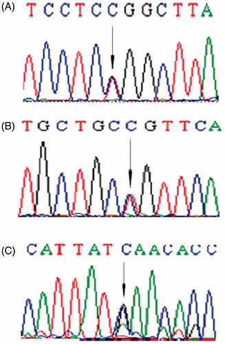 Figure 1. Direct-sequencing exon in NPHS2. The arrows indicate (A) NPHS2 288C > T heterozygous variation in exon 2; (B) 954T > C heterozygous in exon 8; (C) 1038A > G heterozygous in exon 8.