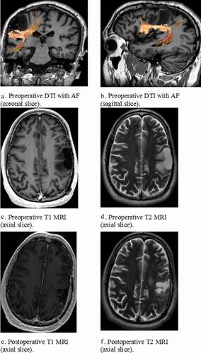 Figure 1. (a-f) Pre- and postoperative Diffusion Tensor Images (DTI) and Magnetic Resonance Imaging (MRI) with reconstruction of the arcuate fasciculus (AF) in patient F.E.