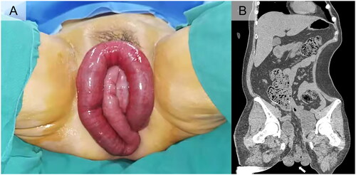 Figure 1. (A) Small intestine protruding from the vagina before operation. (B) The coronal section of the plain CT scan of the pelvis and abdomen (the white arrow indicated the protruded small intestine).