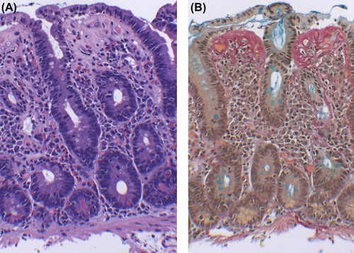 Figure 2. Collagen deposition in duodenal biopsies. A: hematoxylin-eosin. B: Alcian blue/Picro–Sirius red. A diffuse collagen deposition beneath the basement membrane is found. Cellular elements and small capillaries are entrapped in the collagen layer.