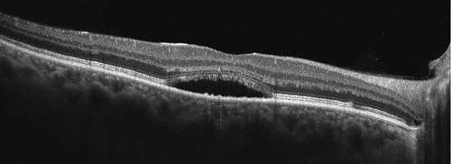 Figure 2. Optical coherence tomography of subretinal fluid in foveal zone. Pachychoroid is present.