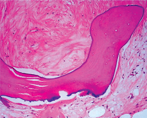 Figure 2. High-power (100 ×) view of fibrovascular tissue in marrow surrounding an allograft trabecula.The dense collagenous tissue is almost acellular, but contains numerous small blood vessel components.