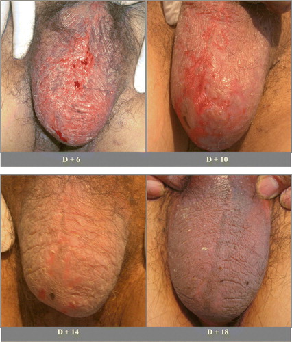 Figure 1.  Photographs of the diffuse erythematous and erosive cutaneous patches on the scrotum and penis. These resolved within 2 weeks.