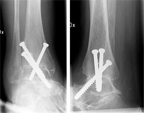 Figure 2. Ankle no.6.Radiographs (A and B) obtained 6 years after percutaneous surgery.The ankle is fused.