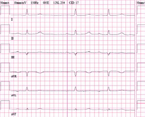 Figure 1. Electrocardiogram of 62-year-old woman with poor R-wave progression (PRWP) without organic heart disease.