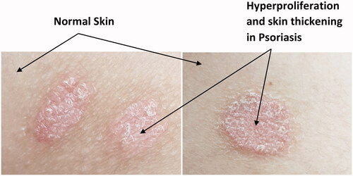 Figure 1. Psoriatic plaques covered with silvery scales compared to normal skin parts.