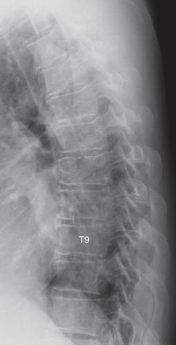 Figure 1. Lateral plain radiograph of the thoracic spine. There were mild degenerative changes in T3 to T11 vertebral bodies and discs.