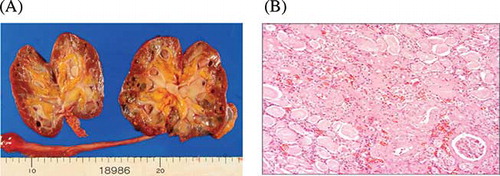 Figure 3. (A) Coronal section of the kidney. Autopsy revealed atrophic kidney and several renal cysts. (B) Light microscopical picture from this case. Only a few numbers of the intact glomeruli were detected. Periodic acid-Schiff stain. Original magnification ×200.