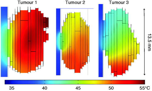 Figure 7. Steady-state temperature distributions in the three tumours.