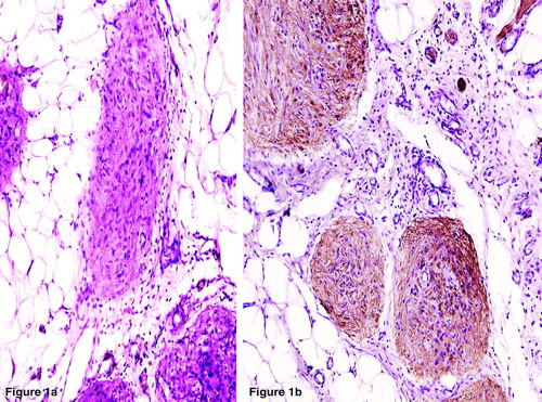 Figure 1.  a. The peritoneal implants and the omental deposits showing diffusely scattered Grade 0 mature astroglial tissues. (H&E×100). b. Positive Glial Fibrillary Acidic Protein (GFAP) immunostaining in the nodules confirming the glial nature. (LSAB×400).