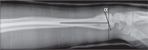 Figure 2. Measuring the sagittal displacement of distal radial fractures in children. α represents the angular displacement caused by the fracture.