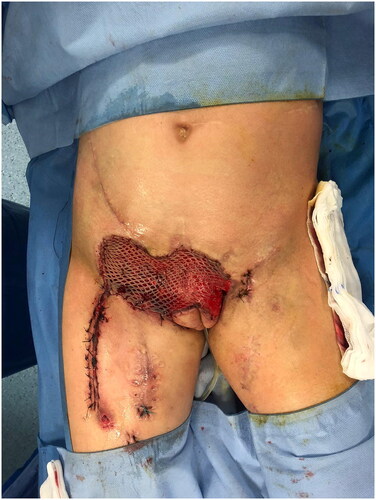 Figure 4. Appearance of the thigh after the skin graft.