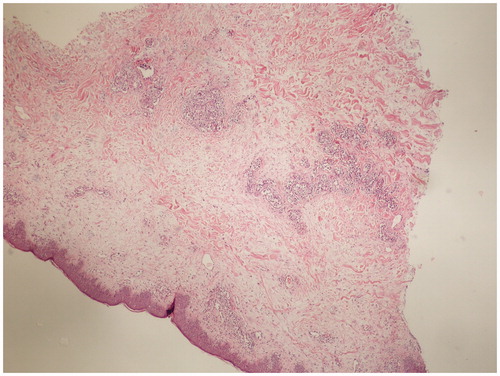 Figure 2. Intravascular large B-cell lymphoma. The large tumor cells fill the vessels in the skin biopsy (H&E stain, original magnification × 4 objective).
