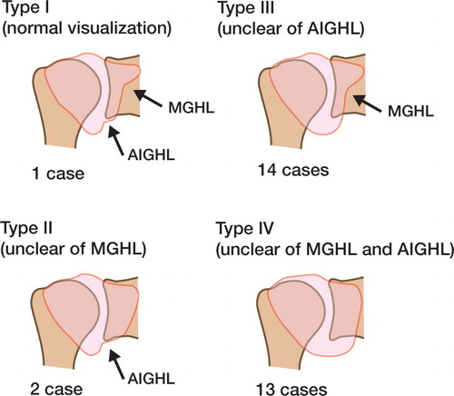 Figure 1. Objective evaluation of the glenohumeral ligament. The tension of the anterior inferior glenohumeral ligament (AIGHL) and medial glenohumeral ligament was evaluated from the internal rotation position to the neutral position of the shoulder. Type III and type IV indicate loosening of the AIGHL. The hollows in the arthrography suggest the tension of the glenohumeral ligament.