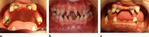 Figure 1. (a,b,c) Increasing number of teeth with caries, missing teeth and shape anomalies in ED cases.