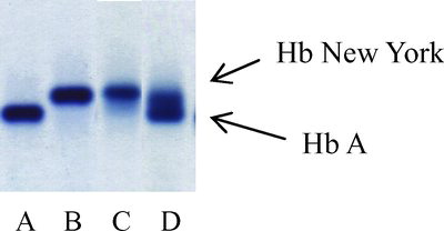 FIGURE 1 Agarose gel electrophoresis at an alkaline pH: (A) a normal subject; (B) a double heterozygote for Hb New York and β0-thalassemia (codon 17); (C) a double heterozygote for Hb New York and β+-thalassemia (−28); (D) a heterozygote for Hb New York.